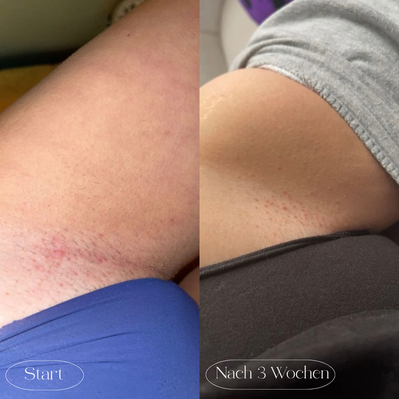 Pickel & Rötungen im Intimbereich