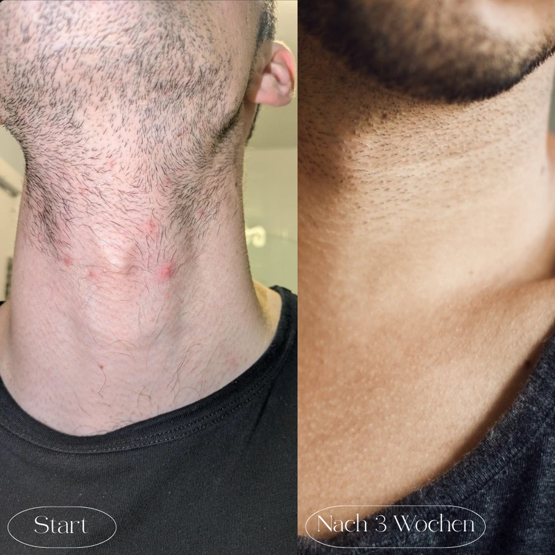 Rasierpickel am Hals